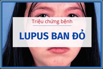 Các triệu chứng bệnh lupus ban đỏ là gì? Tìm hiểu ngay!